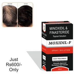MOXIDIL-F Topical Solution for HAIR FALL CONTROL
